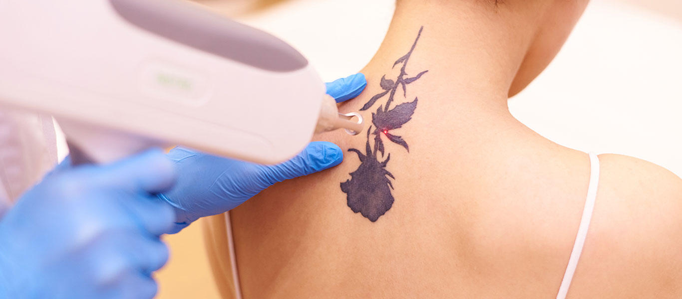 Factors Influencing the Success of Laser Tattoo Removal